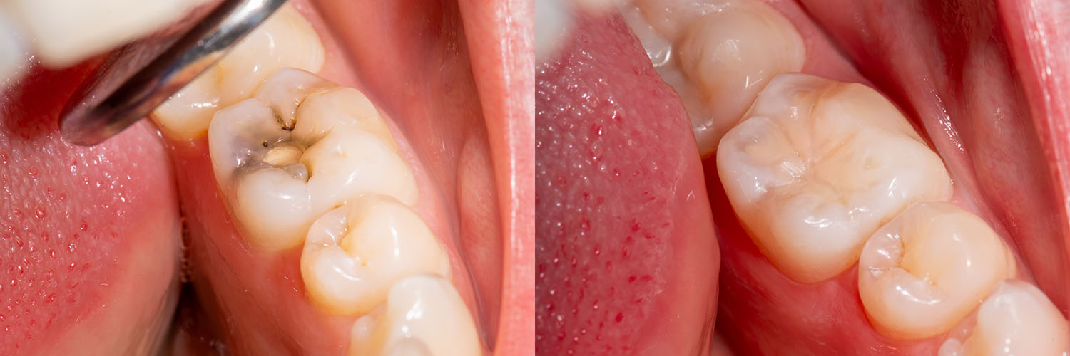 The image displays a close-up view of a mouth with dental implants, showcasing the surgical process of implant placement.