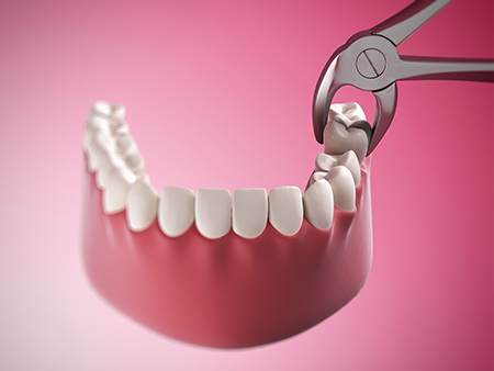The image shows a close-up of a dental tool, possibly a scaler or a pick, being used on a set of teeth with visible plaque and tartar, suggesting a dental cleaning process.