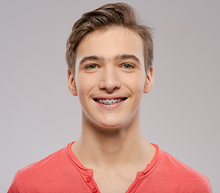 The image shows two photographs of a young man with a smile, one on the left where he appears to be smiling naturally, and another on the right where he has his teeth straightened, likely showing the results of orthodontic treatment.